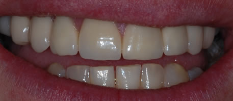 dental implants northern ireland