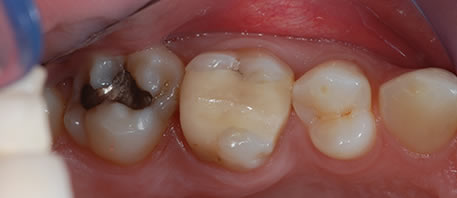 dental implants northern ireland