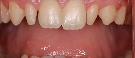 dental implants northern ireland