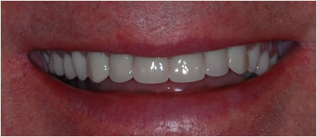 dental implants northern ireland