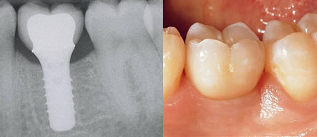 dental implants northern ireland