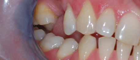 dental implants northern ireland