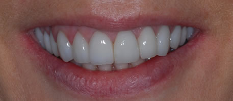 porcelain veneers northern ireland