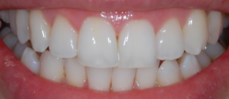 tooth whitening northern ireland