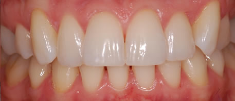 tooth whitening northern ireland