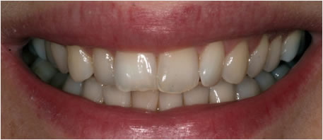 whitening northern ireland