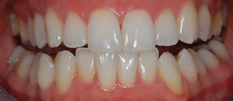 whitening northern ireland